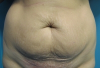 Smagliature: si possono eliminare?